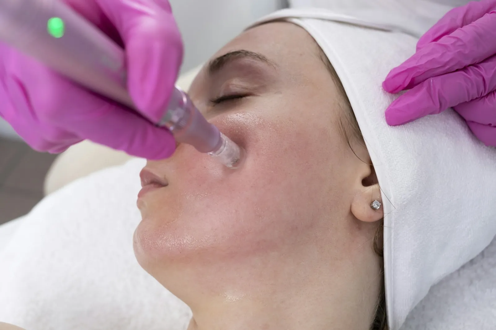 Tratamiento de microneedling facial